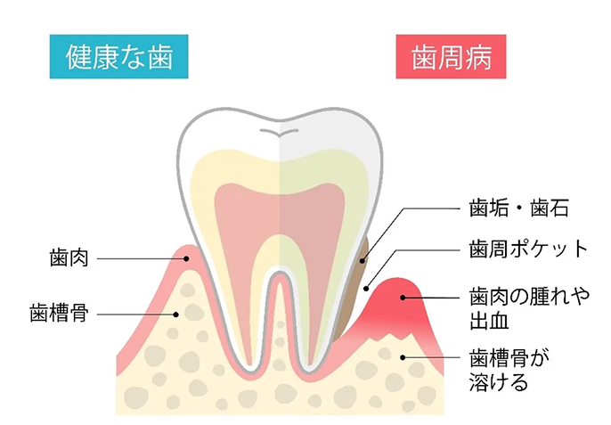 健康な歯と歯周病の歯周組織の違いを比較したイラスト