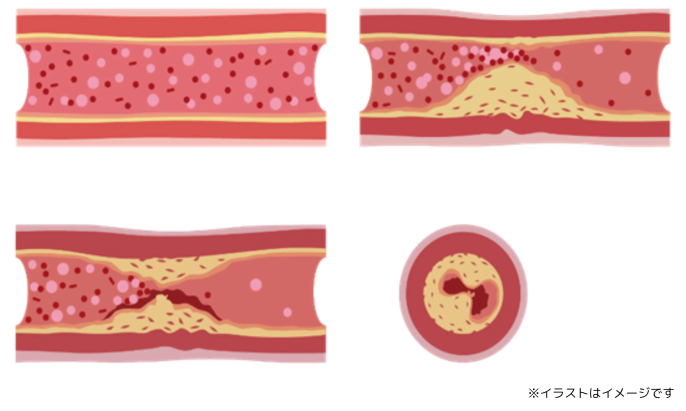 動脈硬化が進行する様子を描いたイラスト