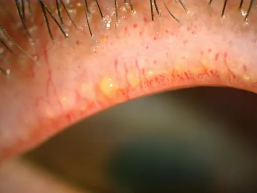 マイボーム腺の機能が低下している写真